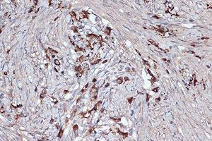 Immunohistochemistry of paraffin-embedded human oophoroma using Xanthine Oxidase (XDH) (XDH) Rabbit mAb (ABIN7271408) at dilution of 1:100 (40x lens).