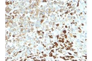 Formalin-fixed, paraffin-embedded human Melanoma stained with NGFR Rabbit Recombinant Monoclonal Antibody (NGFR/2550R). (Recombinant NGFR antibody  (AA 281-421))