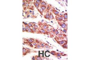 Formalin-fixed and paraffin-embedded human hepatocellular carcinoma tissue reacted with USP12 polyclonal antibody  , which was peroxidase-conjugated to the secondary antibody, followed by AEC staining . (USP12 antibody  (N-Term))