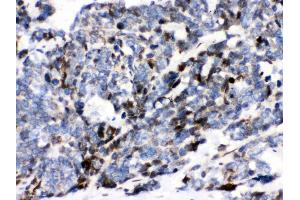 Anti- Ataxin 1 Picoband antibody, IHC(P) IHC(P): Human Lung Cancer Tissue (Ataxin 1 antibody  (C-Term))