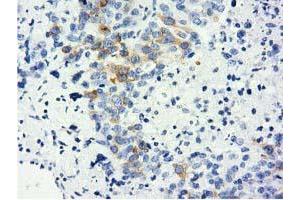 Immunohistochemical staining of paraffin-embedded Adenocarcinoma of Human ovary tissue using anti-LIN7B mouse monoclonal antibody.