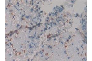 Detection of CR in Human Skin cancer Tissue using Polyclonal Antibody to Calretinin (CR) (Calretinin antibody  (AA 28-248))