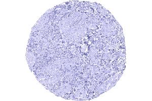 EPCAM immunostaining is lacking in an epitheloid malignant mesothelioma (Recombinant EpCAM antibody  (Extracellular Domain))