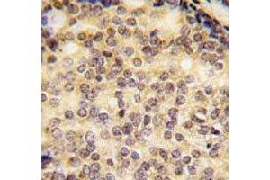IHC analysis of FFPE human prostate carcinoma tissue stained with SOX9 antibody (SOX9 antibody  (AA 41-70))