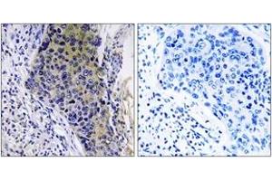 Immunohistochemistry analysis of paraffin-embedded human lung carcinoma tissue, using MRPL34 Antibody. (MRPL34 antibody  (AA 21-70))