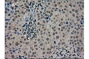Immunohistochemical staining of paraffin-embedded Carcinoma of thyroid tissue using anti-SCYL3mouse monoclonal antibody. (SCYL3 antibody)