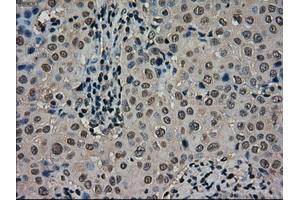 Immunohistochemical staining of paraffin-embedded Carcinoma of thyroid tissue using anti-SCYL3mouse monoclonal antibody.