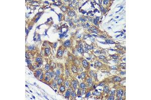 Immunohistochemistry of paraffin-embedded Human lung cancer using L Rabbit pAb (ABIN7265386) at dilution of 1:100 (40x lens). (ARPC5L antibody  (AA 1-100))