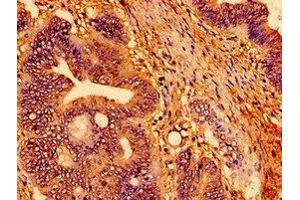 Immunohistochemistry of paraffin-embedded human colon cancer using ABIN7166747 at dilution of 1:100 (TSPO antibody  (AA 12-85))