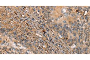 Immunohistochemistry of paraffin-embedded Human cervical cancer tissue using HK3 Polyclonal Antibody at dilution 1:40 (HK3 antibody)