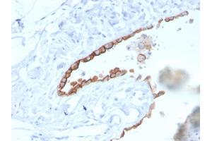 Formalin-fixed, paraffin-embedded human Lung Mesothelioma stained with Mesothelin Mouse Monoclonal Antibody (MSLN/3384). (Mesothelin antibody  (AA 273-407))