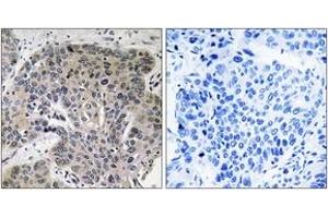 Immunohistochemistry analysis of paraffin-embedded human lung carcinoma tissue, using S100A3 Antibody.