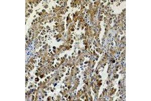 Immunohistochemical analysis of Carbonic Anhydrase 9 staining in human lung cancer formalin fixed paraffin embedded tissue section. (CA9 antibody)