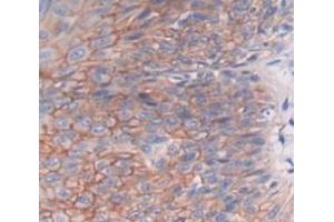IHC-P analysis of skin cancer tissue, with DAB staining. (DHODH antibody  (AA 35-392))