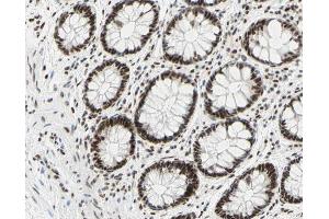 ABIN6267309 at 1/200 staining human colon cancer tissue sections by IHC-P. (C-JUN antibody  (pSer73))