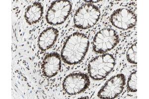 ABIN6267309 at 1/200 staining human colon cancer tissue sections by IHC-P.