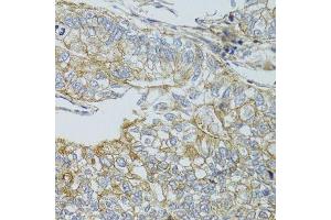 Immunohistochemistry of paraffin-embedded human gastric cancer using CHMP4B antibody. (CHMP4B antibody  (AA 1-224))