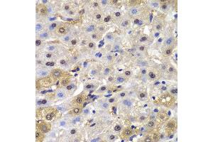 Immunohistochemistry of paraffin-embedded human liver cancer using MAD1L1 antibody at dilution of 1:100 (400x lens).
