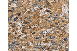 Immunohistochemistry of Human liver cancer using SULT1B1 Polyclonal Antibody at dilution of 1:30 (SULT1B1 antibody)