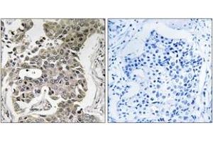 Immunohistochemistry analysis of paraffin-embedded human breast carcinoma tissue, using PPP2R1B Antibody.