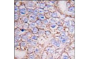 Formalin-fixed and paraffin-embedded human breast carcinoma tissue reacted with ERK8 antibody (N-term), which was peroxidase-conjugated to the secondary antibody, followed by DAB staining. (MAPK15 antibody  (N-Term))