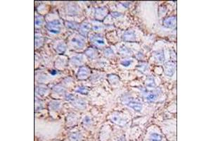 Formalin-fixed and paraffin-embedded human breast carcinoma tissue reacted with ERK8 antibody (N-term), which was peroxidase-conjugated to the secondary antibody, followed by DAB staining. (MAPK15 antibody  (N-Term))