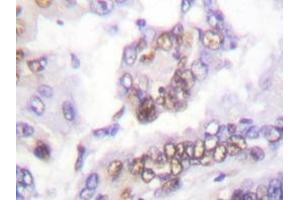 Immunohistochemistry analyzes of AML1 antibody in paraffin-embedded human lung carcinoma tissue. (RUNX1 antibody)