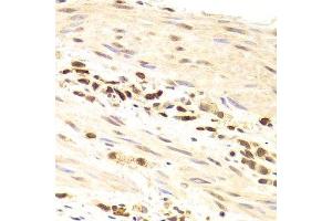 Immunohistochemistry of paraffin-embedded human gastric cancer using PRPF3 Antibody. (PRPF3 antibody  (AA 1-280))
