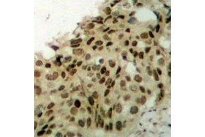 Immunohistochemical analysis of APTX staining in human breast cancer formalin fixed paraffin embedded tissue section. (Aprataxin antibody)