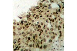 Immunohistochemical analysis of APTX staining in human breast cancer formalin fixed paraffin embedded tissue section.