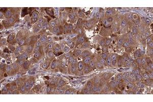 ABIN6273681 at 1/100 staining Human liver cancer tissue by IHC-P. (JAML antibody  (C-Term))