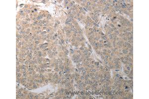 Immunohistochemistry of Human liver cancer using SLC1A4 Polyclonal Antibody at dilution of 1:70 (SLC1A4 antibody)