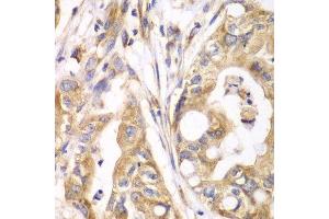 Immunohistochemistry of paraffin-embedded human liver cancer using TXNRD2 antibody. (TXNRD2 antibody  (AA 100-310))