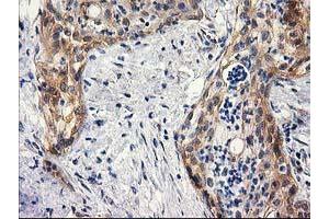 Immunohistochemical staining of paraffin-embedded Carcinoma of Human pancreas tissue using anti-BCAR1 mouse monoclonal antibody.