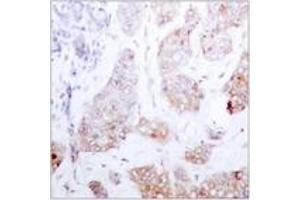 Immunohistochemistry analysis of paraffin-embedded human breast carcinoma tissue, using C-RAF (Ab-259) Antibody.