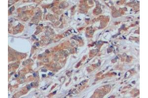 Detection of FN in Human Breast cancer Tissue using Polyclonal Antibody to Fibronectin (FN) (Fibronectin antibody  (AA 1998-2106))