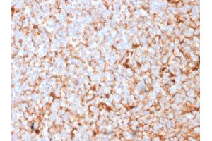 Formalin-fixed, paraffin-embedded human Breast Carcinoma stained with Monospecific Mouse Monoclonal Antibody (SPM518) to Mammaglobin.