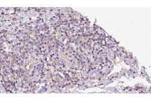ABIN6273152 at 1/100 staining Human lymph cancer tissue by IHC-P. (PYGB antibody  (C-Term))