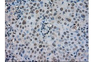 Immunohistochemical staining of paraffin-embedded Carcinoma of thyroid tissue using anti-SOD1mouse monoclonal antibody. (SOD1 antibody)