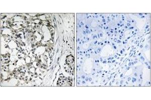 Immunohistochemistry analysis of paraffin-embedded human breast carcinoma tissue, using PEX14 Antibody. (PEX14 antibody  (AA 117-166))
