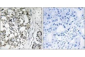 Immunohistochemistry analysis of paraffin-embedded human breast carcinoma tissue, using PEX14 Antibody.
