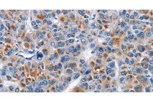 Immunohistochemistry of paraffin-embedded Human liver cancer tissue using CREB2 Polyclonal Antibody at dilution 1:40 (ATF4 antibody)