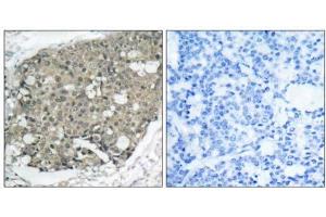 Immunohistochemical analysis of paraffin-embedded human breast carcinoma tissue using Akt (Ab-308) antibody (E021055). (AKT1 antibody)