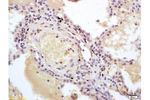 Formalin-fixed and paraffin embedded human lung carcinoma labeled with Anti-IRF7 Polyclonal Antibody, Unconjugated (ABIN682603) at 1:200 followed by conjugation to the secondary antibody and DAB staining.