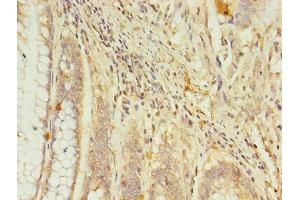 Immunohistochemistry of paraffin-embedded human colon cancer using ABIN7167621 at dilution of 1:100 (RGS7 antibody  (AA 1-487))