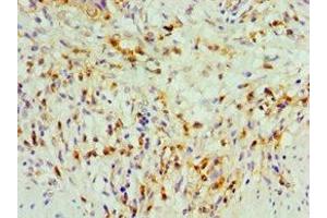 Immunohistochemistry of paraffin-embedded human gallbladder tissue using ABIN7171776 at dilution of 1:100 (TDGF1 antibody  (AA 35-188))