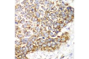 Immunohistochemistry of paraffin-embedded human esophageal cancer using TFAM antibody (ABIN6290990) at dilution of 1:100 (40x lens).