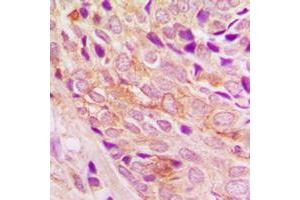 Immunohistochemical analysis of PI3K p110 alpha staining in human breast cancer formalin fixed paraffin embedded tissue section. (PIK3CA antibody  (Center))