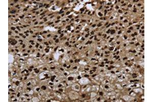 The image on the left is immunohistochemistry of paraffin-embedded Human esophagus cancer tissue using ABIN7189815(ANP32E Antibody) at dilution 1/20, on the right is treated with synthetic peptide. (ANP32E antibody)
