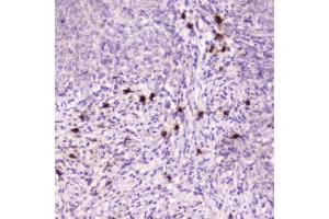 IHC testing of FFPE human sarcoma with Ribonuclease 3 antibody at 2ug/ml. (RNASE3 antibody  (AA 28-160))